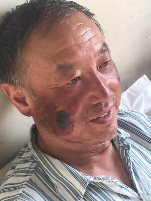 在此次攀登珠峰的过程中冻伤的脸颊